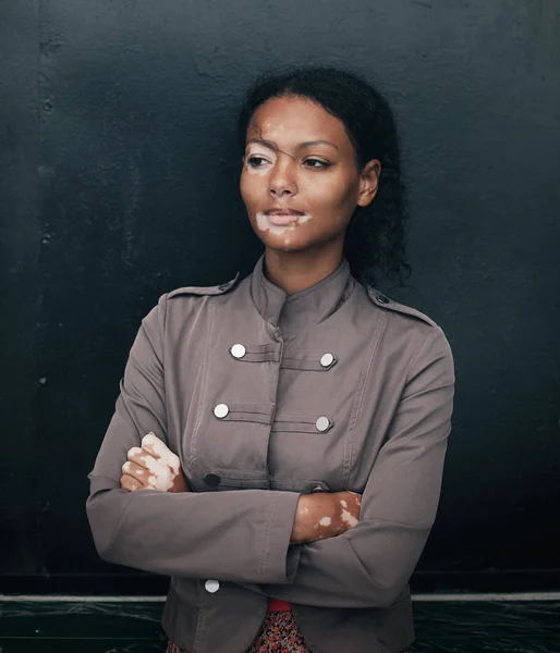 Vacker ung brunett kvinna med vitiligo sjukdom — Stockfoto