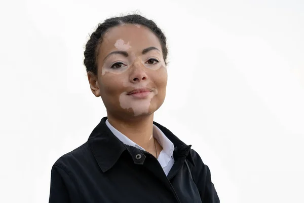 Ein schönes junges Mädchen afrikanischer Herkunft mit Vitiligo isoliert auf weißem Hintergrund — Stockfoto
