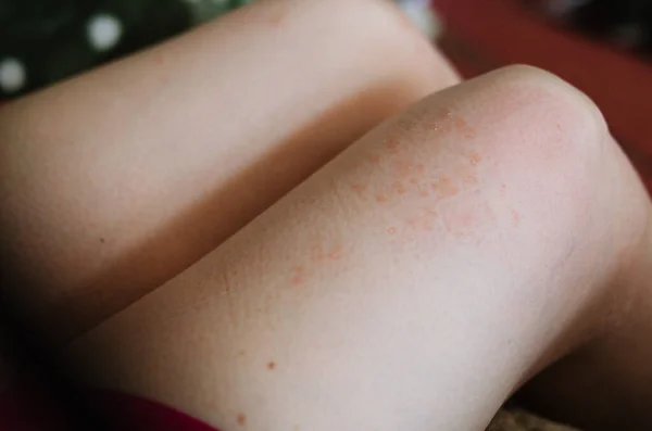 Kadının Dizinde Sedef Hastalığı Var Deride Kırmızı Noktalar — Stok fotoğraf