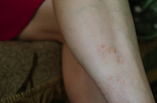 Ψωρίαση Στο Πόδι Κατά Διάρκεια Της Ύφεσης Κοντά Δέρμα Γυναικών — Φωτογραφία Αρχείου