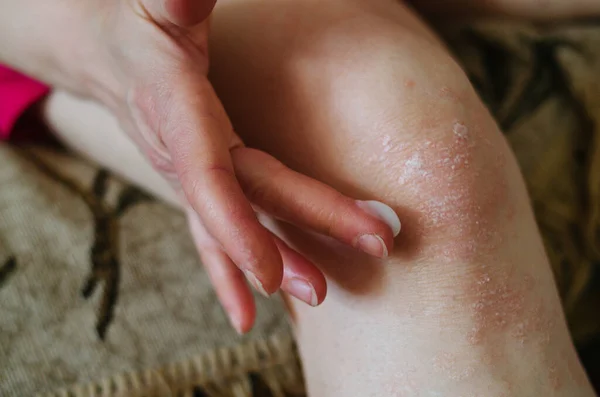 Macro Women Hand Applying Cream Emollient Knee Skin Treatment Psoriasis — Stock Photo, Image