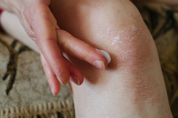 Macro of women's hand applying an cream emollient to knee skin as in the treatment of psoriasis.