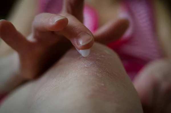 Γυναίκες Που Εφαρμόζουν Κρέμα Μαλακτικό Στο Δέρμα Του Γόνατος Όπως — Φωτογραφία Αρχείου