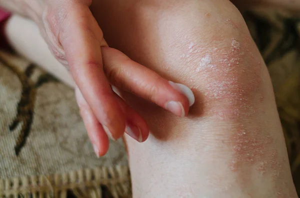 Μακροχρόνιο Χέρι Των Γυναικών Εφαρμόζοντας Μια Κρέμα Μαλακτικό Στο Δέρμα — Φωτογραφία Αρχείου