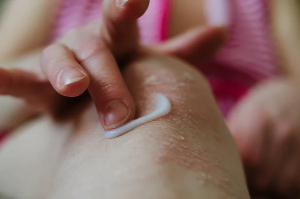 Psoriasis Leg Woman Close Red Spots White Flakes Skin Knee Stock Image