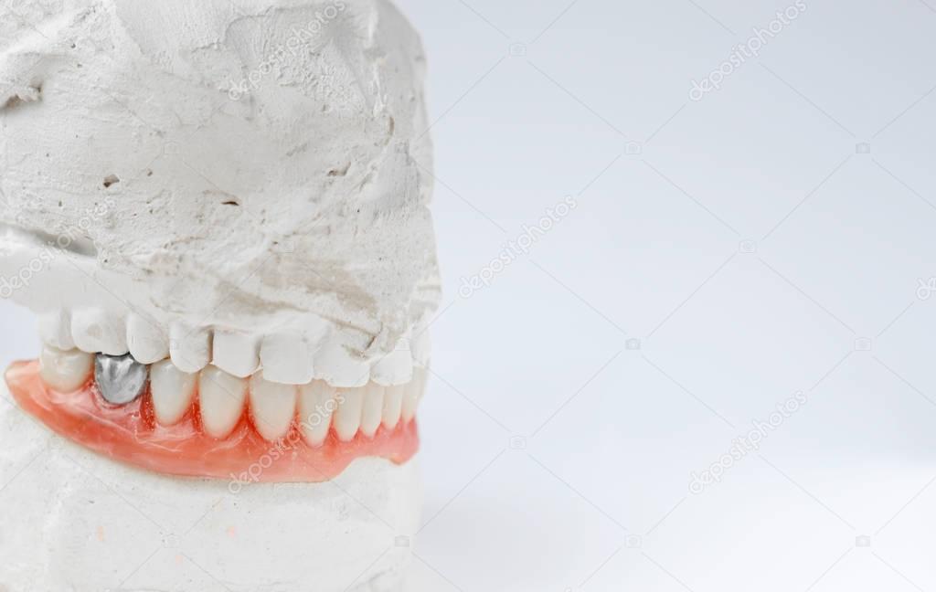 Artificial tooth, dental prosthesis with false silver tooth, metalic crown on tooth.