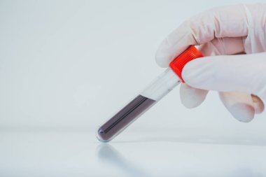 Pozitif Covid-19 testi. Coronavius salgını krizi. Laboratuvarda bir tüpte kan örneği.. 