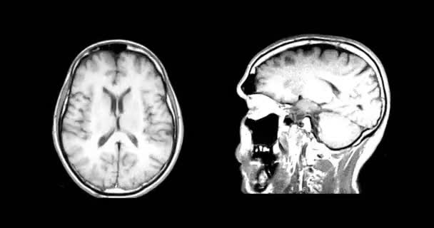 Hjärnans Topp Och Sidosnitt Mrt Scan Diagnostisk Medicinsk Verktygsövervakning — Stockvideo