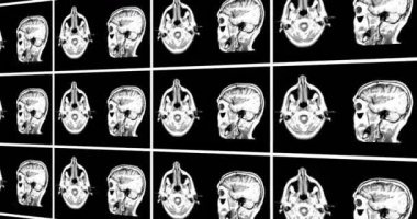 Beyin üstü ve yanal kesik Mrt scan. Teşhis Tıbbi Araç Monitörü 2d Canlandırma