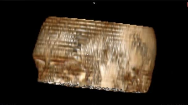 Tomografia Computadorizada Com Imagem Crânio Humano Normal Tela Computador Médico — Vídeo de Stock