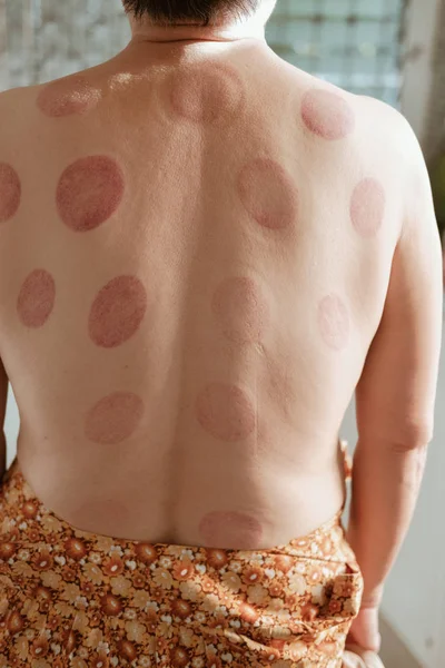 Blood patch mark on back after chinese cupping massage treatment — Stock Photo, Image
