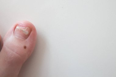 Ingrown toenail treatment. The results of drugs for the treatment of fungal infections and ingrown nails. Bracket, toenail clamp