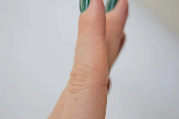 Cicatriz Dedo Homem Sobre Fundo Branco Cicatriz Corte Queimadura Uma — Fotografia de Stock