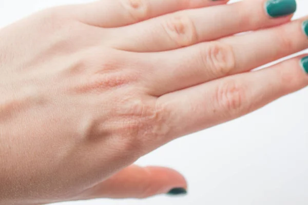 Feche Mão Feminina Com Uma Cicatriz Queimadura Curada Conceitos Saúde — Fotografia de Stock