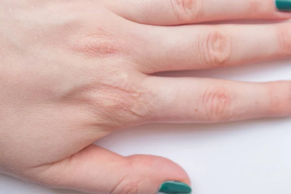 Close Weibliche Hand Mit Einer Verheilten Brandnarbe Konzepte Von Gesundheit — Stockfoto