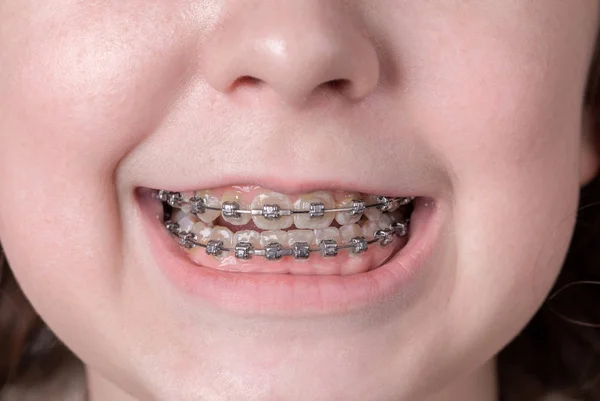 Metal diş telleri ile geniş gülümseme kız. — Stok fotoğraf