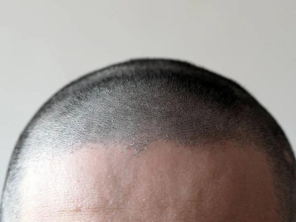 top of man's head with short hair