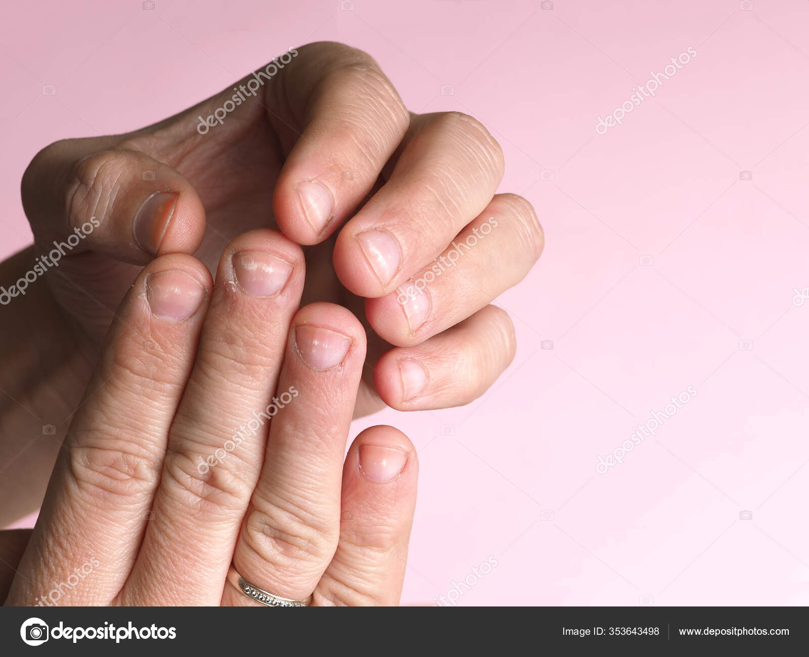 White Spots Nails Male Hand Caused Deficiency Calcium Zinc Poisoning Stock  Photo by ©AxOst 353643498