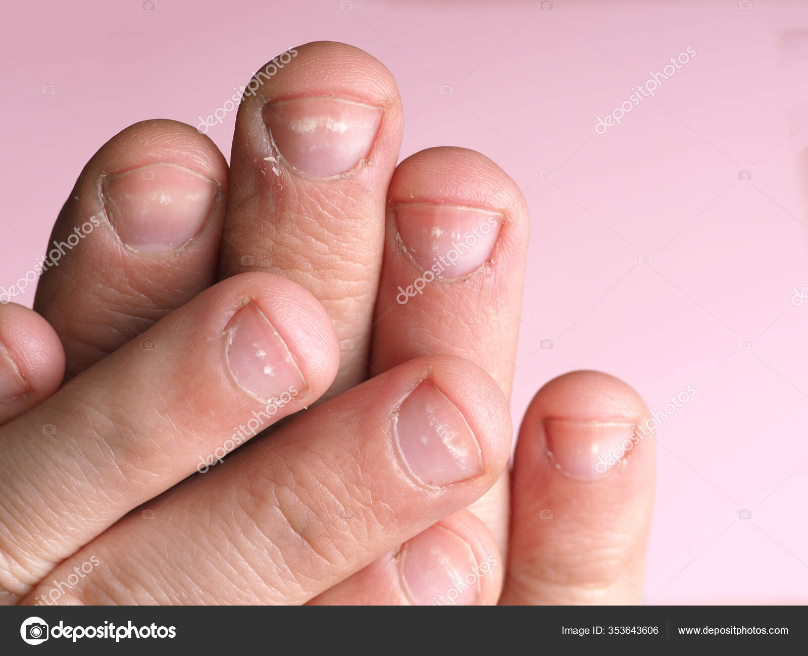 White Spots Nails Male Hand Caused Deficiency Calcium Zinc Poisoning Stock  Photo by ©AxOst 353643606