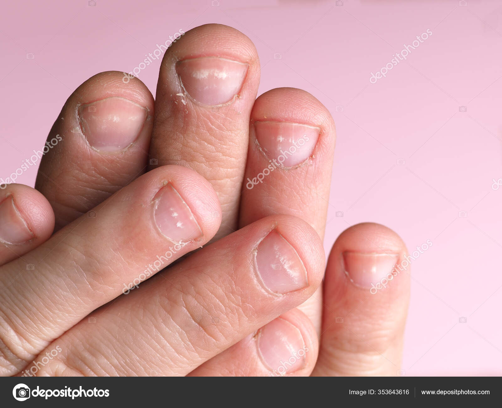 White Spots Nails Male Hand Caused Deficiency Calcium Zinc Poisoning Stock  Photo by ©AxOst 353643616