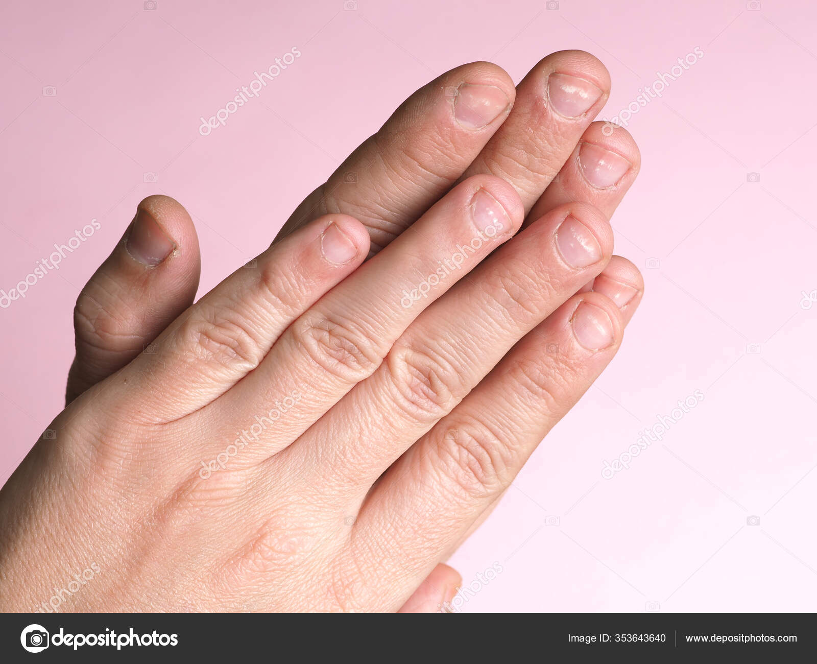 White Spots Nails Male Hand Caused Deficiency Calcium Zinc Poisoning Stock Photo by ©AxOst 353643640