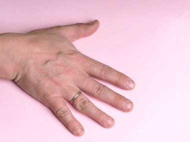 Erkek elinin tırnaklarındaki beyaz noktalar kalsiyum eksikliği, çinko ya da evdeki kimyasalların pembe arka planda zehirlenmesinden kaynaklanıyor. Bu hastalığın adı lökonychia..