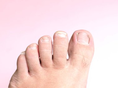 Pembe arka planda pedikür olmayan erkek ayağında uzun tırnaklar.