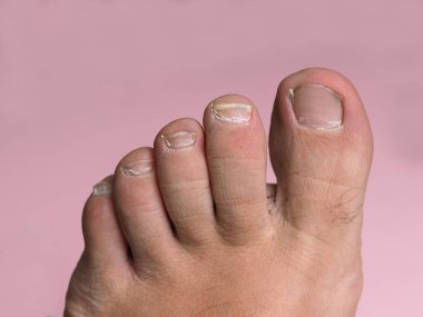 Pembe arka planda pedikür olmayan erkek ayağında uzun tırnaklar.