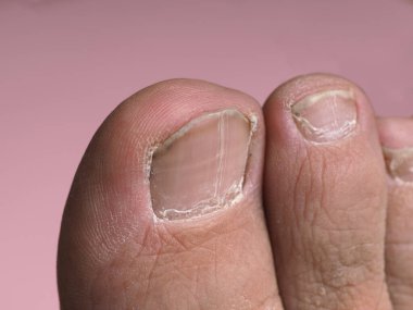 Pembe arka planda pedikür olmayan erkek ayağında uzun tırnaklar.