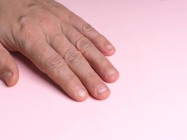 White Spots Nails Male Hand Caused Deficiency Calcium Zinc Poisoning — Stock Photo, Image