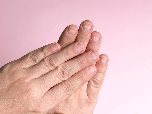 White Spots Nails Male Hand Caused Deficiency Calcium Zinc Poisoning — Stock Photo, Image