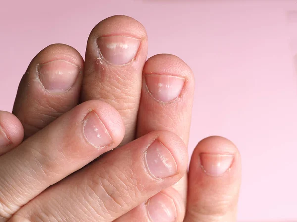 White spots on the nails of the male hand caused by a deficiency of  calcium, zinc or poisoning by household chemicals on a pink background.  This disease is called leukonychia. - Stock