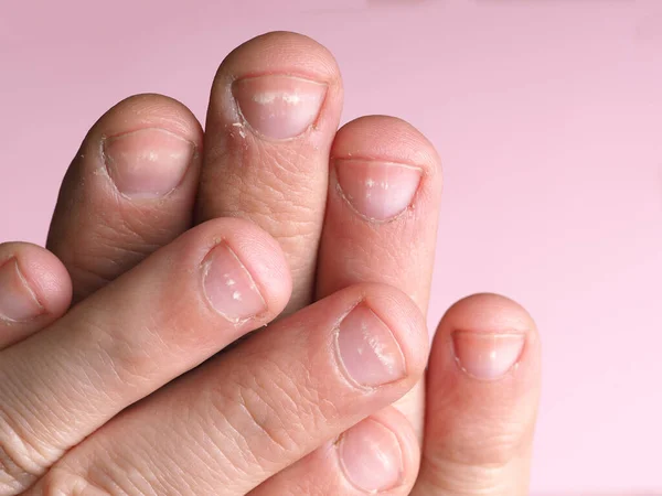 Manchas Blancas Las Uñas Mano Masculina Causadas Por Una Deficiencia — Foto de Stock