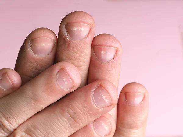 White Spots Nails Male Hand Caused Deficiency Calcium Zinc Poisoning — Stock Photo, Image