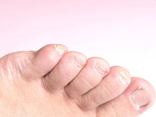 Long Nails Male Foot Pedicure Pink Background — Stock Photo, Image