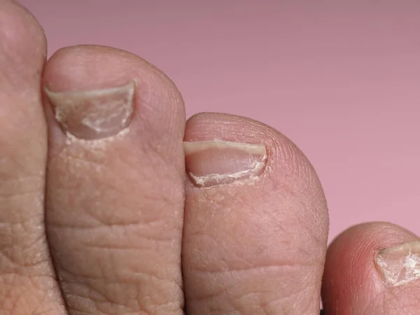 Μακριά Νύχια Αρσενικό Πόδι Χωρίς Πεντικιούρ Ροζ Φόντο — Φωτογραφία Αρχείου