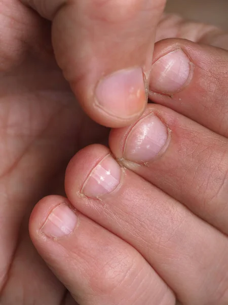 Manchas Blancas Las Uñas Mano Masculina Causadas Por Una Deficiencia — Foto de Stock