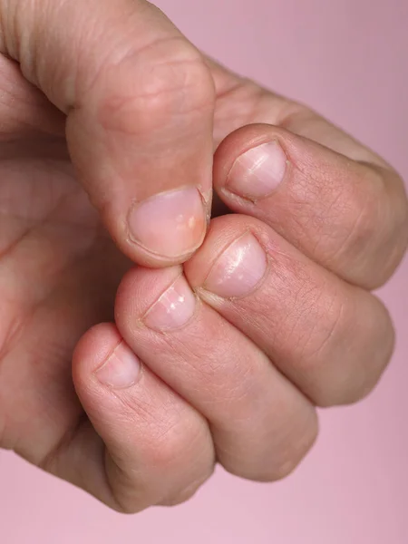 Manchas Blancas Las Uñas Mano Masculina Causadas Por Una Deficiencia — Foto de Stock