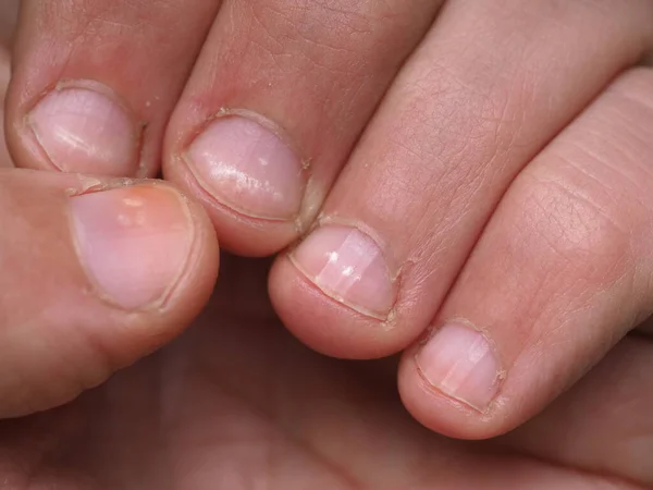 White Spots Nails Male Hand Caused Deficiency Calcium Zinc Poisoning — Stock Photo, Image