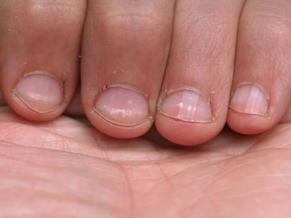 White Spots Nails Male Hand Caused Deficiency Calcium Zinc Poisoning — Stock Photo, Image