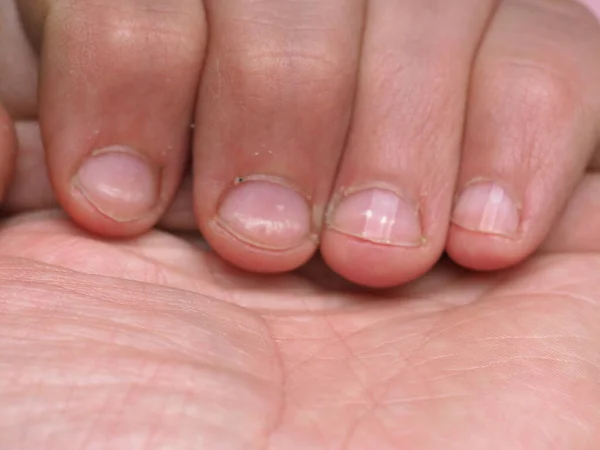 White Spots Nails Male Hand Caused Deficiency Calcium Zinc Poisoning — Stock Photo, Image