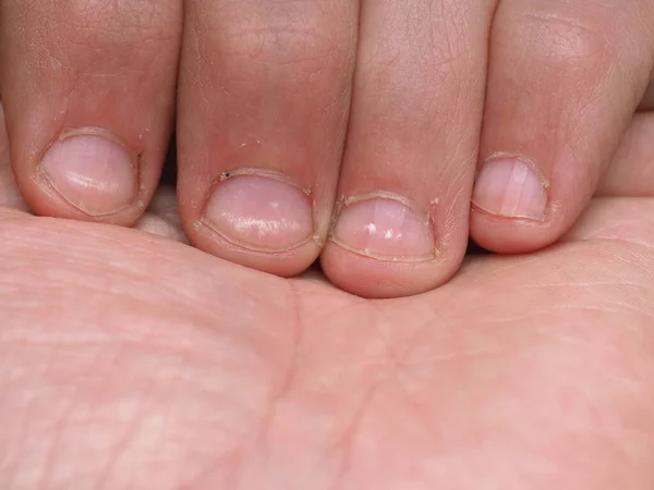 White Spots Nails Male Hand Caused Deficiency Calcium Zinc Poisoning — Stock Photo, Image