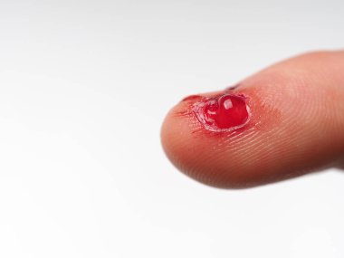 Yırtık derili erkek ayak parmağı (kişisel yaralanma, ilk yardım))