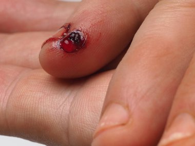 Yırtık derili erkek ayak parmağı (kişisel yaralanma, ilk yardım))