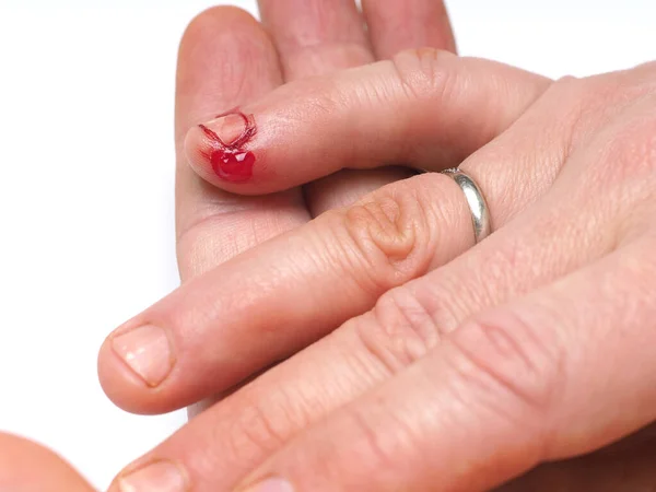 Αρσενικό Δάχτυλο Του Ποδιού Σκισμένο Αιμορραγικό Δέρμα Σωματικό Τραυματισμό Πρώτες — Φωτογραφία Αρχείου