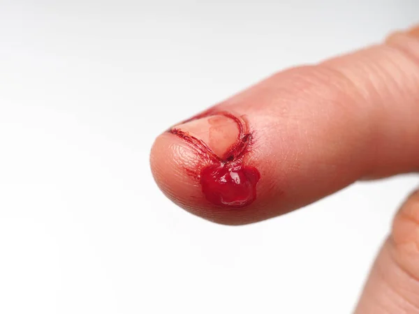 Αρσενικό Δάχτυλο Του Ποδιού Σκισμένο Αιμορραγικό Δέρμα Σωματικό Τραυματισμό Πρώτες — Φωτογραφία Αρχείου