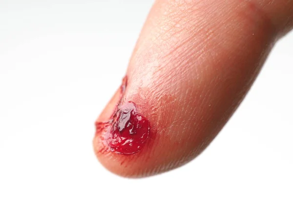 Yırtık Derili Erkek Ayak Parmağı Kişisel Yaralanma Ilk Yardım — Stok fotoğraf