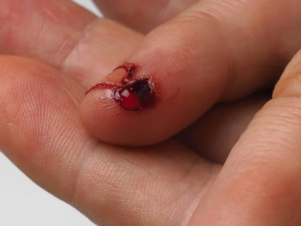 Мужской Палец Ноги Разрывной Кровотечения Кожи Травма Первая Помощь — стоковое фото