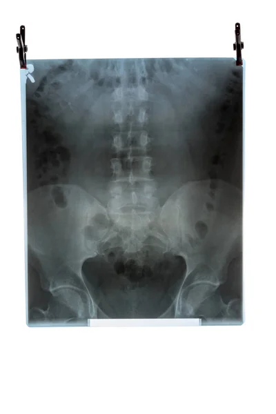 Рентгеновское Изображение Позвоночника Тазобедренной Кости Перед Светящейся Стеной Удерживаемой Зажимами — стоковое фото