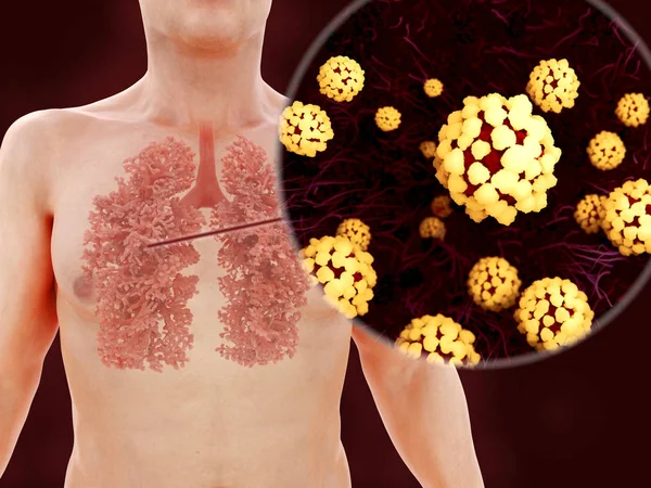 Sars disease, coronaviruses in the lung — Stock Photo, Image